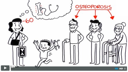 NOS and USBJI create osteoporosis animated video