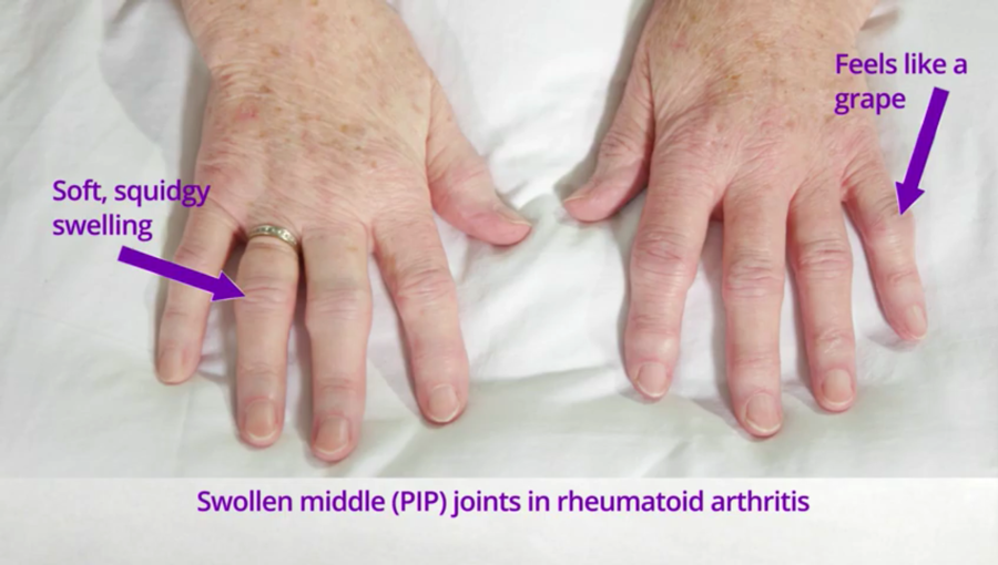 How to selfexamine for tender and swollen joints in RA