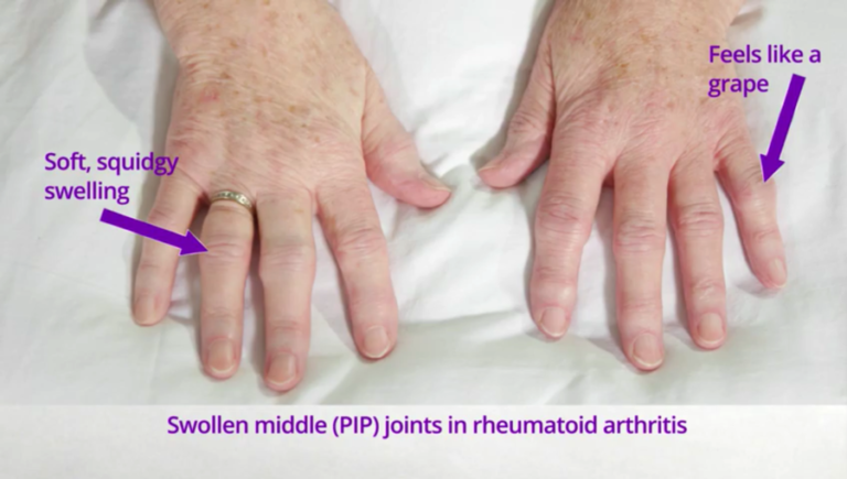 Swollen Joints This Womans Diagnosis Will Change Your Perspective - k2lh0cm